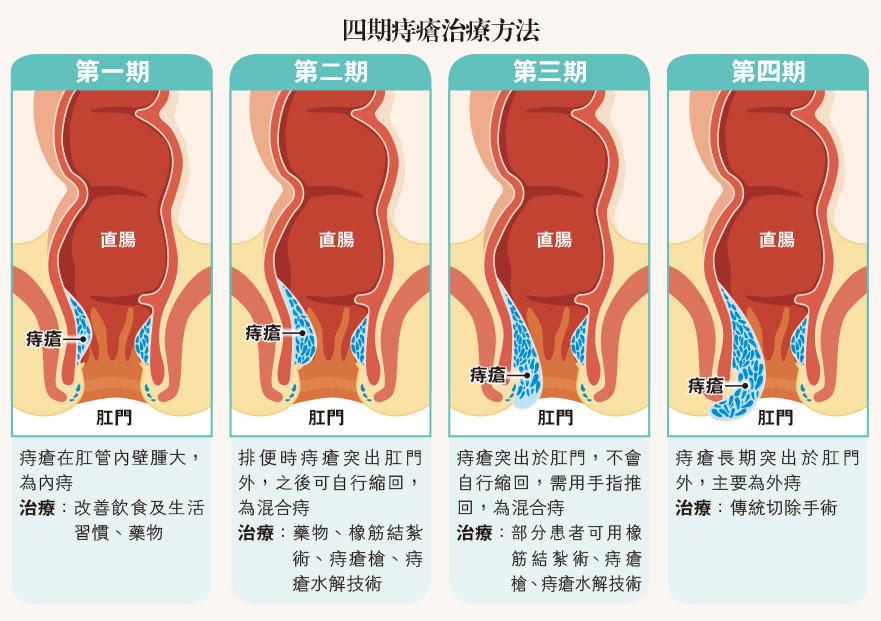 毋須開刀 創傷小 新招「電死」痔瘡無痛？