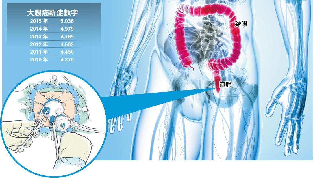 【了解腸癌】微創切瘤減風險 新手術治直腸癌 免割肛之苦