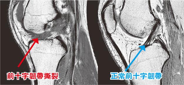 【運動消閒】滑雪傷膝 韌帶撕裂手尾長 初哥高手皆易中招