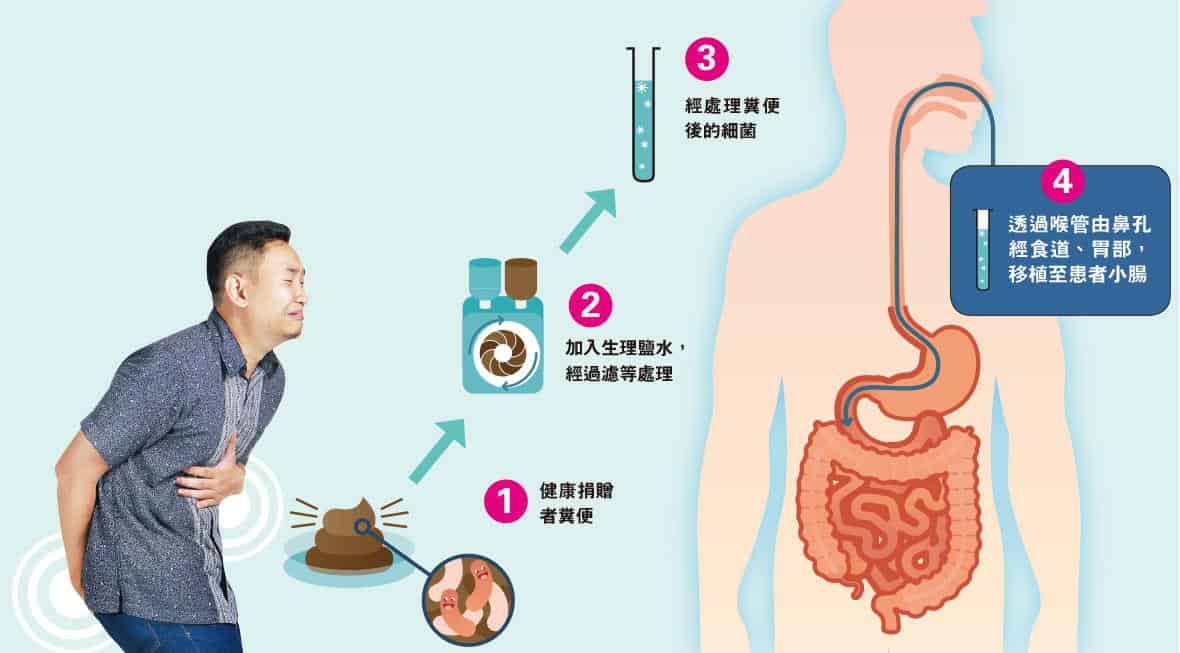 【過敏系列】排泄物變醫學界新星 糞便移植治腸易激？