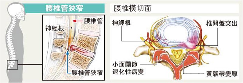 腰椎管收窄,腳痛,郭業東,黃仕雄,椎間盤突出,脊椎關節炎,黃韌帶肥厚,脊髓腫瘤,