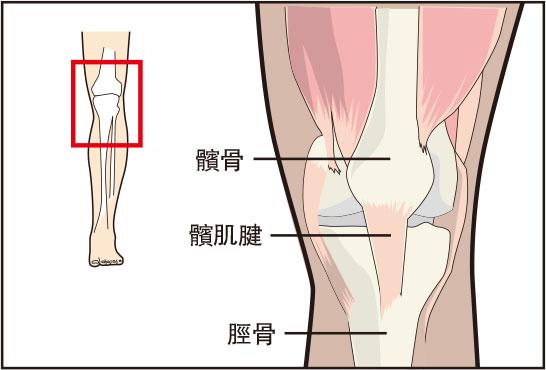 骨骼「偵」奇：「跳躍者膝」疼痛難走路