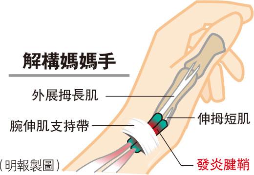 媽媽手,拇指肌腱急性發炎