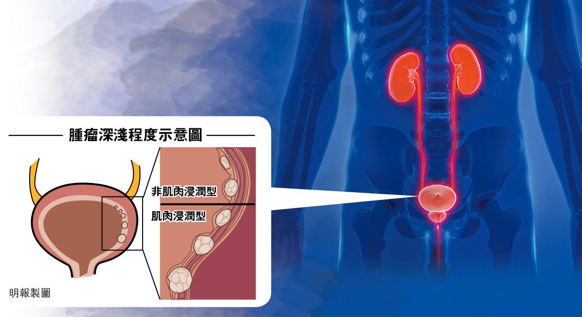 磁力共振新技術 膀胱癌睇真啲