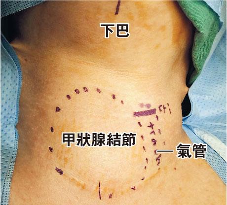 【淋巴癌】知多啲：淋巴結持續腫大 「癌」機四伏