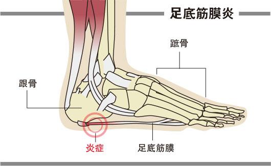 腳跟刺痛, 足底筋膜炎, 扁平足, 高弓足, 足跟肌腱過短,