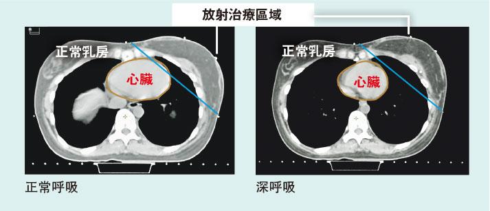 【乳癌電療】善用呼吸法護心 減輻射引致心病風險