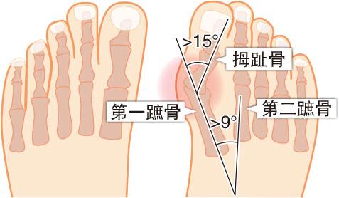 骨骼「偵」奇：芭蕾舞鞋隱藏「波子骨」