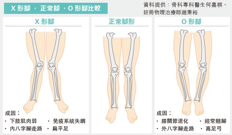 【有片】腿變形成因多 運動未必拉得直 O形：膝退化 X形：或免疫系統疾病