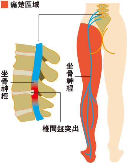 工作長時間屈身 傷神經腰痛腳痺