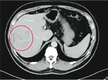 中期肝癌有望根治 兩招夾擊 先縮後除