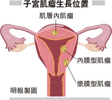 子宮肌瘤靠「拖」應對 小心變惡