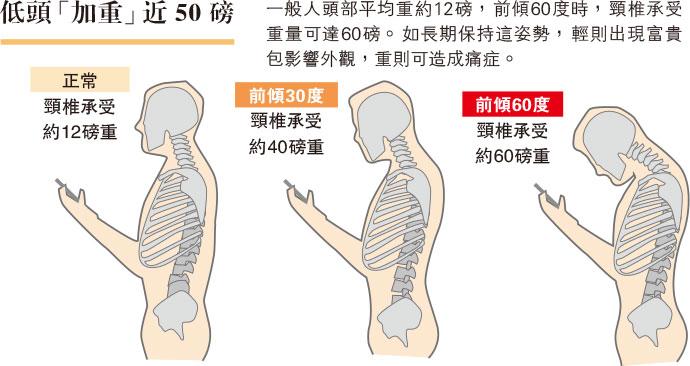 【有片】WFH長期低頭致頸生富貴包？ 骨折風險增七成 窒礙腦供血