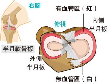 姿治通鑑：半月板創傷 治療要「分區」