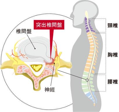 跳躍着地脊椎受壓 籃球傷腰腳痹痛