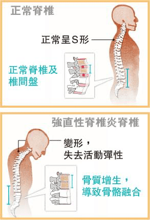 【痛症】正視強直性脊椎炎 戒煙好過亂驗基因