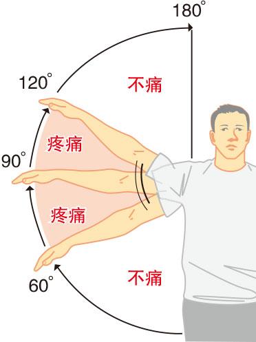 天氣凍 五十肩？筋骨痛症發作？物理治療師教你簡易運動、自行檢測參考