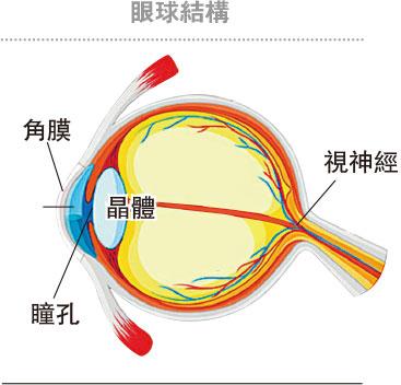 【有片】「鴛鴦眼」矯視非人人適應 白內障手術咪早咪遲