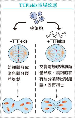 【腦腫瘤】存活期延長 無嚴重副作用 無創「電場」 對付兇惡腦癌