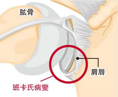 【肩關節脫位】慣性甩骱 伸懶腰都出事？ 20歲前受傷 再脫位風險近90％