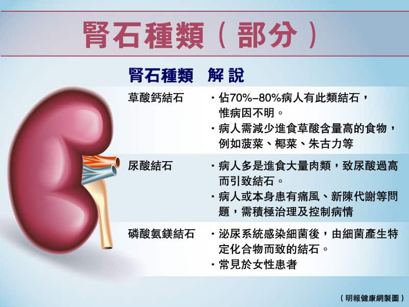 【腎石】腎結石致腰背疼痛 注意兩大成因 體外衝擊波碎石助解困局（附：減低腎石風險5個Tips）