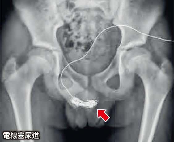 【情緒健康】《香港醫學雜誌》刊兩宗罕見學童塞異物入體內個案 醫生：案例半年近20宗 精神科醫生：若疫下長困家中易現焦慮、抑鬱