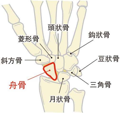 【骨折】手腕「舟骨」骨折病徵不明顯 手腕僵硬難活動