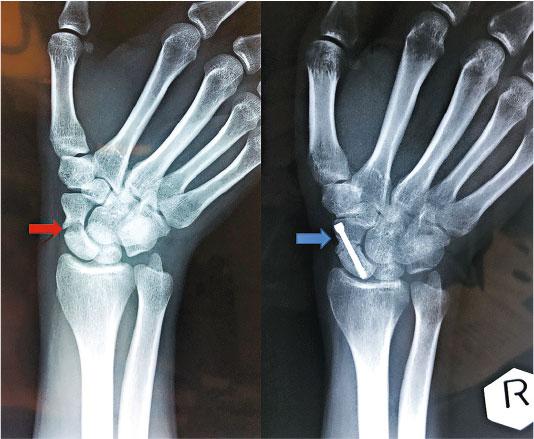 【骨折】手腕「舟骨」骨折病徵不明顯 手腕僵硬難活動