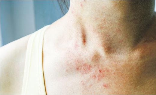 濕疹——濕疹疹塊較大，邊界模糊，表面亦常有脫皮情况。（kitzcorner＠iStockphoto）