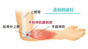 【網球肘】手腕伸肌勞損致病變發炎無力 網球肘5個徵狀 誰是高危一族 4招改善方法