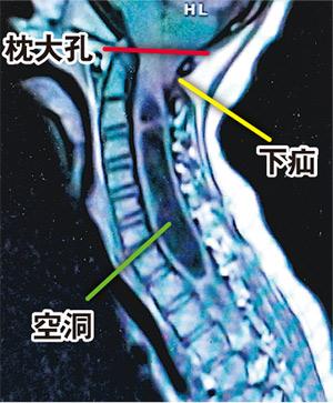 枕大孔：正常小腦不應低於此位置／小腦扁桃體下疝：枕大孔擠迫影響脊髓液流動／脊髓空洞症：脊髓液積聚膨脹，影響神經功能引致脊椎側彎（作者提供）