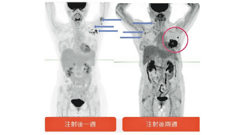 【乳癌】有研究指接種新冠疫苗後3周內接受PET掃描 八成機會出現乳房腫瘤「假陽性」