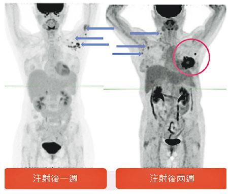 市民打針一周後做掃描（圖左），顯示打針位置附近的左臂及腋下淋巴腫脹（紫箭嘴示）；乳癌患者打針後兩周掃描（圖右），發現打針位的右臂附近淋巴腫大。（香港乳癌基金會）