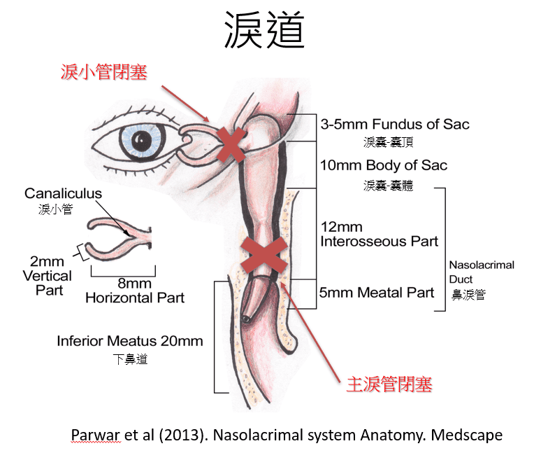 大部分淚管閉塞都沒有特定成因，男女老幼都可以無故出現阻塞。若不及時處理，有機會引致眼睛發炎、化膿等。