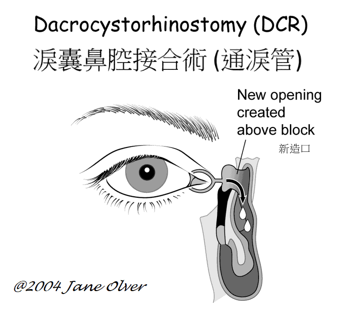 淚囊鼻腔接合術：在鼻骨開出一個切口，構建淚水的新造口。