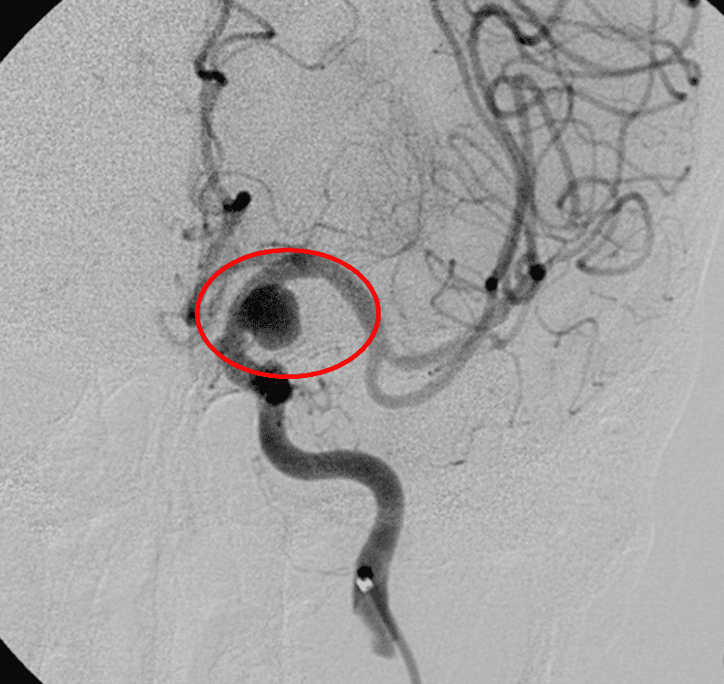 術前血管造影，紅圈為動脈瘤位置。