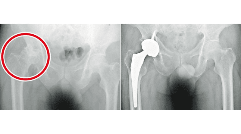 【髖關節炎】常見4大成因：關節退化、骨折 痛楚持續發炎惡化 需接受人工髖關節置換手術