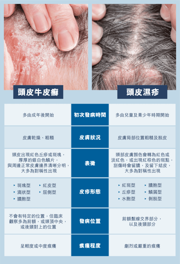 頭皮牛皮癬被誤診為濕疹 慘現脫髮問題？中醫教你重新辨別兩大常見頭皮疾病