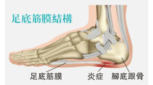 【足底筋膜炎】成因與長時間站立、肥胖、扁平足有關？與足底筋膜撕裂有何不同？哪些人士屬高危群組？