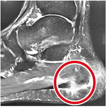 MRI影像——磁力共振（MRI）影像顯示足底筋膜撕裂（紅圈）。（作者提供）