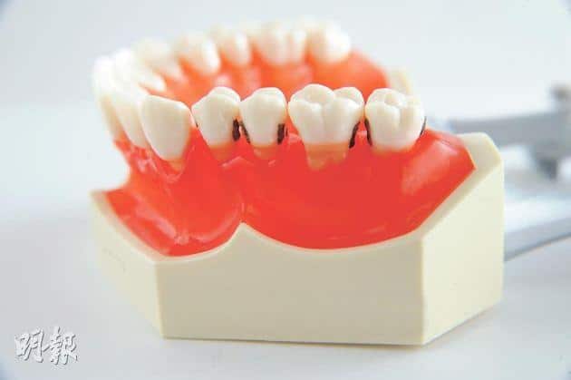 當蛀牙或因創傷導致牙質缺損，很多時都需要補牙，不過，自助補牙有機會出現填充物料無法緊貼牙齒，讓食物和牙菌膜容易積聚，嚴重甚至會出現二度蛀牙及牙齦發炎等問題。（資料圖片）