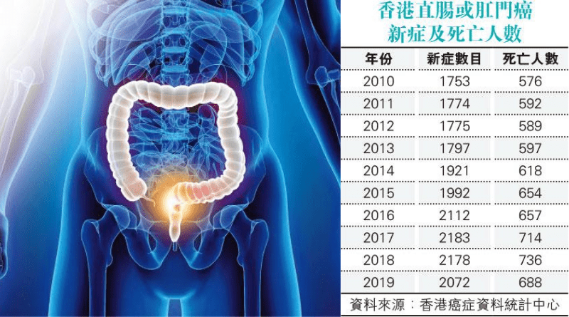 【直腸癌】研究：直腸癌患者半年免疫治療 腫瘤100%消失 減傳統療法後遺症 復發及長期治癒率未知之數