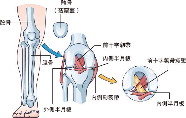 前十字韌帶撕裂「卜」一聲關節脫位 血水積聚關節僵硬 自我癒合難