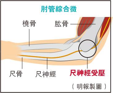 【痛症】肘管綜合徵３成因 初期病徵：手肘前臂刺痛腫脹無力 惡化或致「爪狀手」