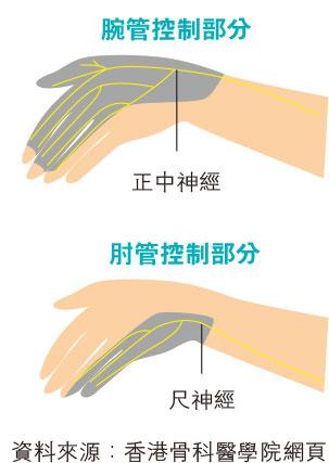 【痛症】肘管綜合徵３成因 初期病徵：手肘前臂刺痛腫脹無力 惡化或致「爪狀手」