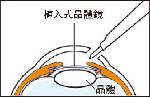 激光矯視3種手術PRK、LASIK、SMILE 比較 哪些人適合植入式矯視手術 救大近視、老花？