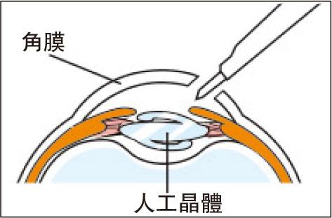 激光矯視3種手術PRK、LASIK、SMILE 比較 哪些人適合植入式矯視手術 救大近視、老花？