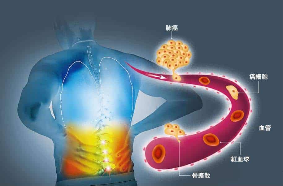 關於癌症骨擴散的8個問題 前列腺癌、乳癌、肺癌較易骨轉移?引致痹痛骨折?等於骨癌?