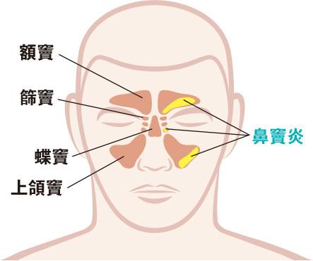 【鼻竇炎】持續鼻塞 鼻黏膜受炎症刺激增生鼻瘜肉致鼻水倒流 可致睡眠窒息失嗅覺