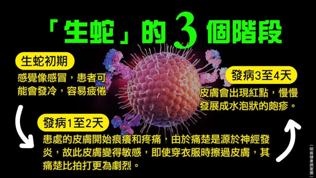 生蛇可再復發？72小時黃金治療期？接種疫苗可減後遺症？拆解5個生蛇常見問題